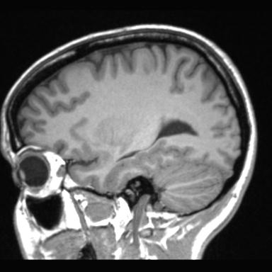 File:Atretic encephalocoele with inferior vermis hypoplasia (Radiopaedia 30443-31108 Sagittal T1 38).jpg