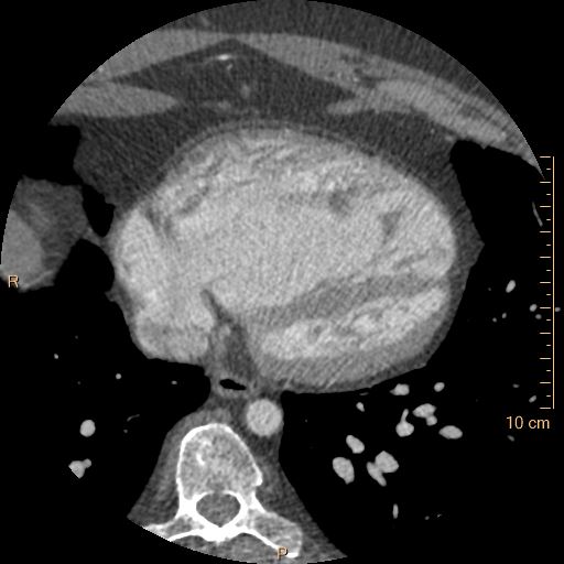Atrial septal defect (upper sinus venosus type) with partial anomalous pulmonary venous return into superior vena cava (Radiopaedia 73228-83961 A 207).jpg
