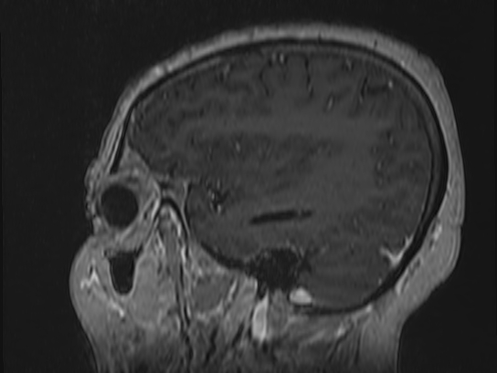 Atypical meningioma (Radiopaedia 62985-71406 Sagittal T1 C+ 17).jpg