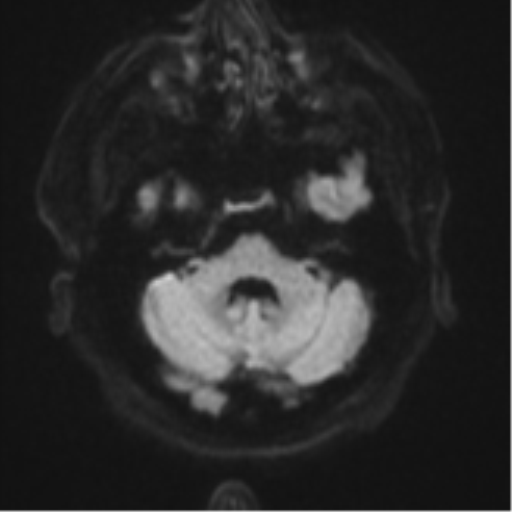 Atypical meningioma (WHO grade II) with brain invasion (Radiopaedia 57767-64729 Axial DWI 37).png