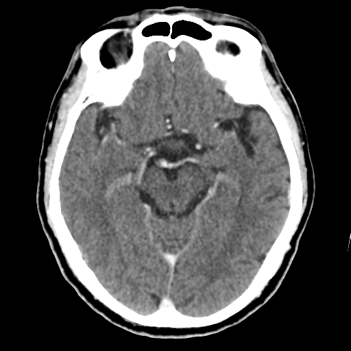 Atypical meningioma (WHO grade II) with osseous invasion (Radiopaedia 53654-59715 Axial C+ delayed 23).png