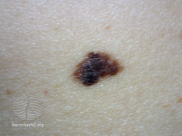 File:Atypical naevus (DermNet NZ lesions-atyp3).jpg