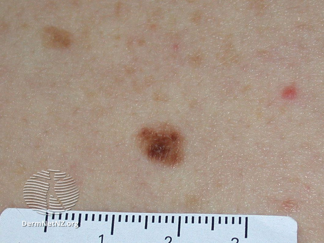 File:Atypical naevus (DermNet NZ lesions-atypical-naevi-584).jpg