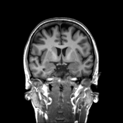 Autoimmune limbic encephalitis (Radiopaedia 30363-31005 Coronal T1 34).jpg