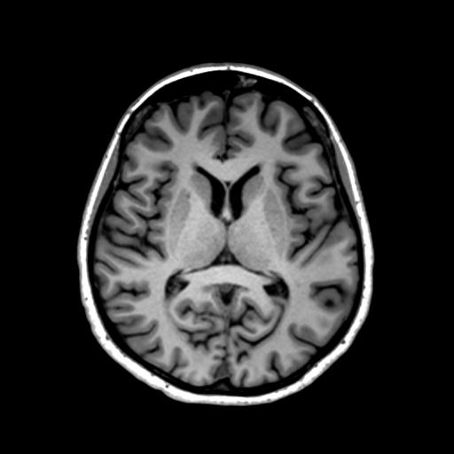 Autoimmune limbic encephalitis (Radiopaedia 30363-31005 T1 Axial 1mm 83).jpg