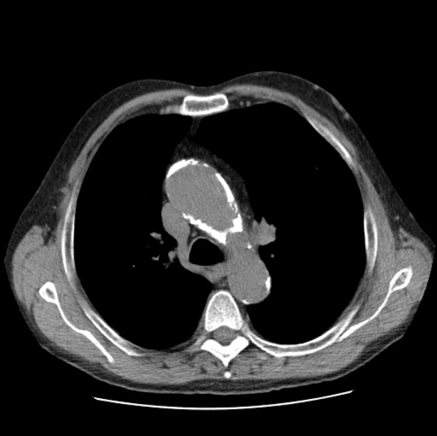 Autosomal dominant polycystic kidney disease (Radiopaedia 27851-28094 Axial non-contrast 20).jpg