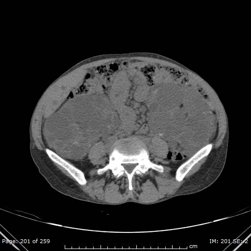 Autosomal dominant polycystic kidney disease (Radiopaedia 44122-47684 Axial non-contrast 72).jpg