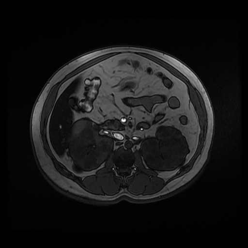Autosomal dominant polycystic kidney disease (Radiopaedia 50259-55611 Axial 2D Dual Echo 43).jpg