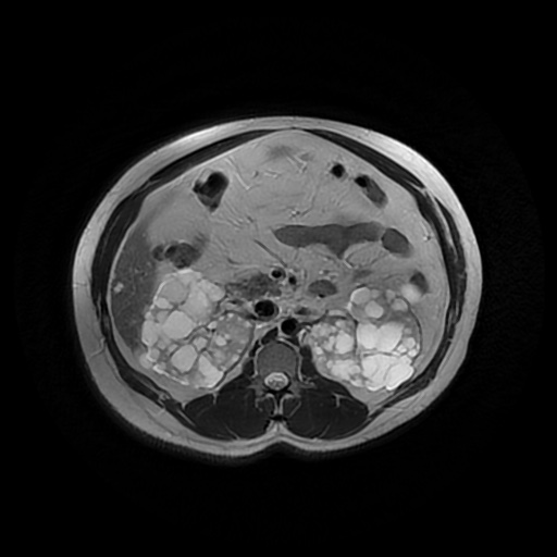 File:Autosomal dominant polycystic kidney disease (Radiopaedia 50259-55611 Axial T2 21).jpg