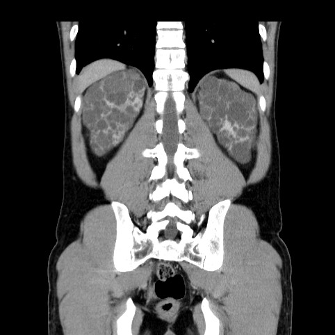 Autosomal dominant polycystic kidney disease (Radiopaedia 66349-75582 A 71).jpg