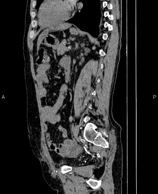 Autosomal dominant polycystic kidney disease (Radiopaedia 87830-104287 C 57).jpg