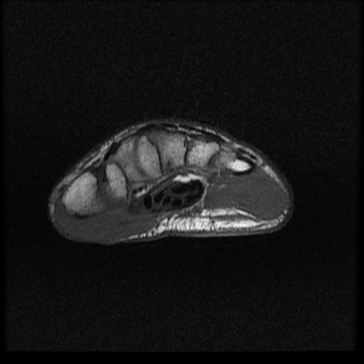 File:Avascular necrosis - scaphoid non-union (Radiopaedia 63457-72065 Axial T1 3).jpg