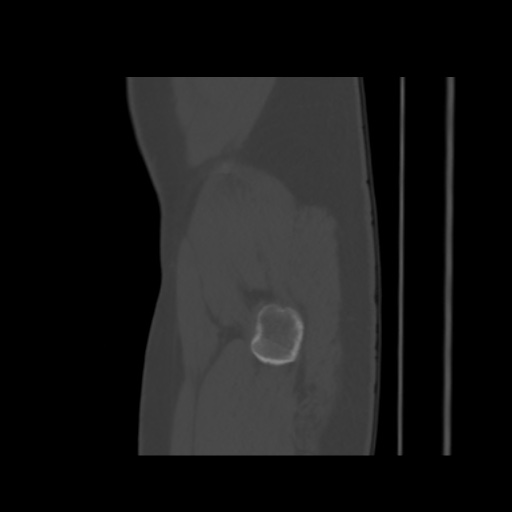 File:Avascular necrosis of the hip (Radiopaedia 61503-69467 B 3).jpg