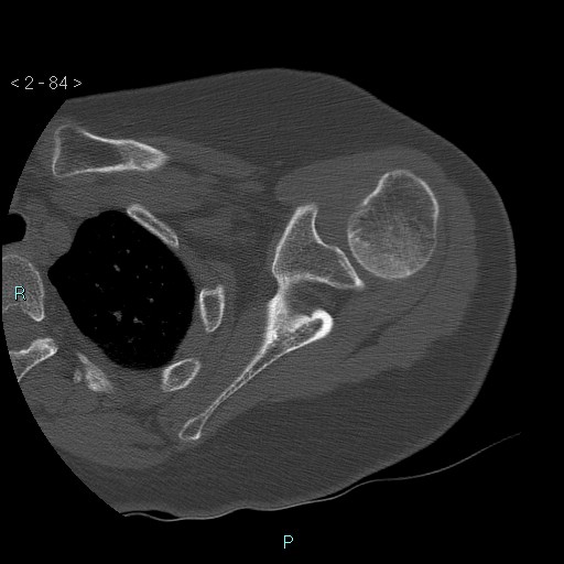 File:Avascular necrosis of the shoulder - Cruess stage I (Radiopaedia 77674-89887 Axial bone window 21).jpg