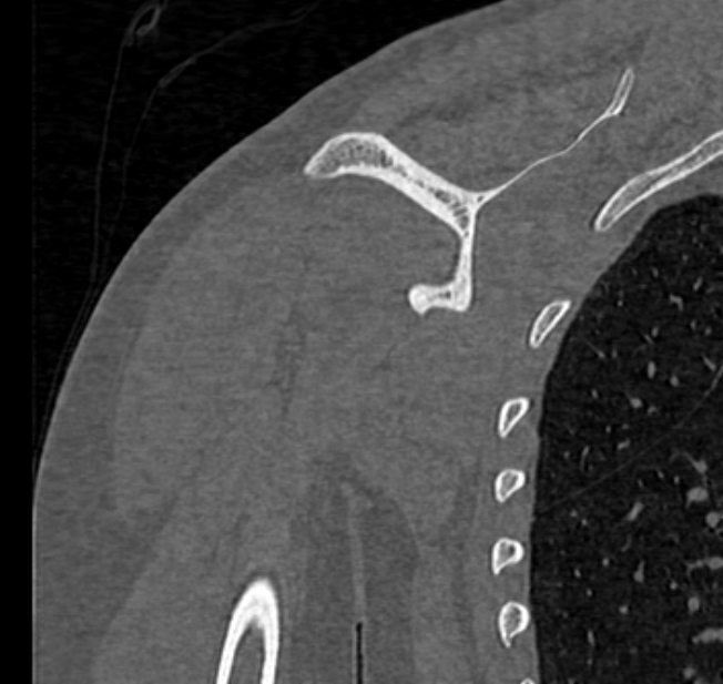 Avulsion fracture - greater tuberosity of humerus (Radiopaedia 71216-81514 Coronal bone window 49).jpg