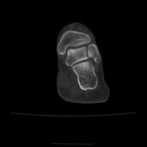 Avulsion fracture of the dorsal cuboid bone (Radiopaedia 51586-57377 Axial bone window 15).jpg