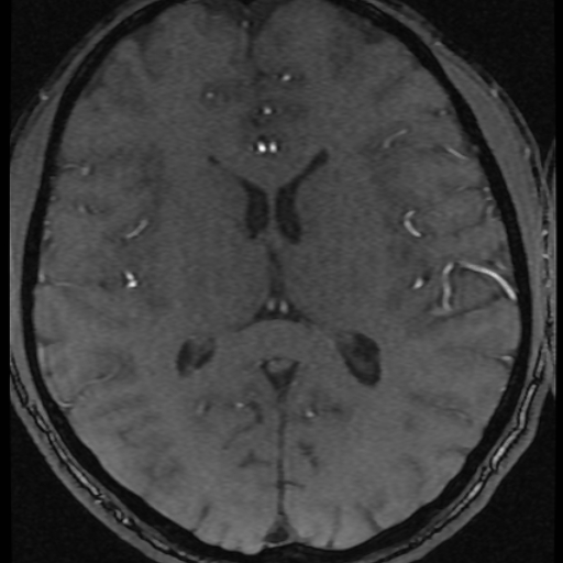 Azygos anterior cerebral artery (Radiopaedia 17059-16756 Axial MRA 2).jpg