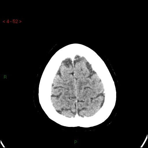 Azygos anterior cerebral artery (Radiopaedia 51987-57833 A 52).jpg