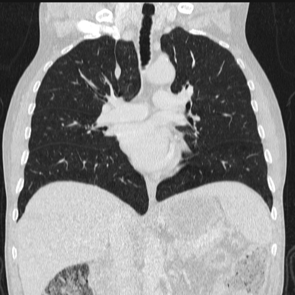 Azygos lobe (Radiopaedia 38259-40275 Coronal lung window 41).jpg