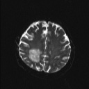 Balo concentric sclerosis (Radiopaedia 50458-55940 Axial DWI 7).jpg