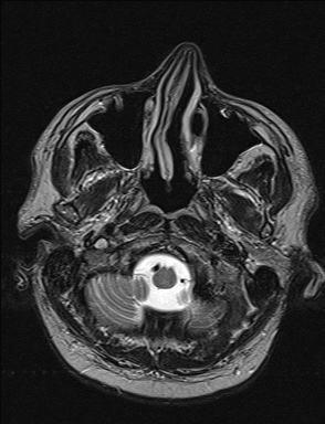 File:Balo concentric sclerosis (Radiopaedia 50458-55940 Axial T2 41).jpg