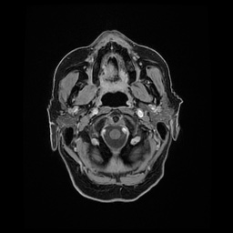 Balo concentric sclerosis (Radiopaedia 53875-59982 Axial LAVA C+ 22).jpg