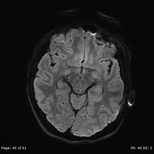 Balo concentric sclerosis (Radiopaedia 61637-69636 Axial DWI 45).jpg