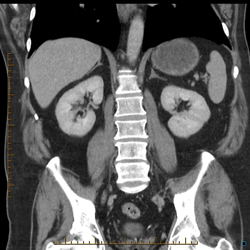 File:Bariatric balloon causing gastric outlet obstruction (Radiopaedia 54449-60672 B 39).jpg