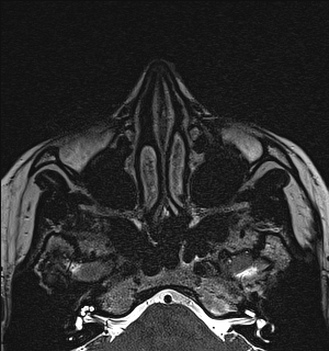 Basal cell carcinoma - nasal region (Radiopaedia 70292-80365 Axial Gradient Echo 38).jpg
