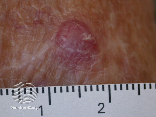 File:Basal cell carcinoma affecting the face (DermNet NZ lesions-bcc-face-0992).jpg