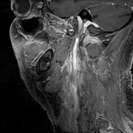 Base of tongue squamous cell carcinoma (Radiopaedia 31174-31884 F 48).jpg