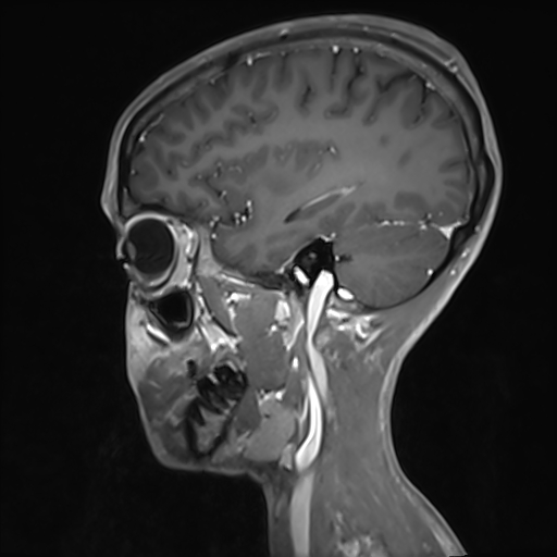 File:Basilar artery perforator aneurysm (Radiopaedia 82455-97733 G 107).jpg