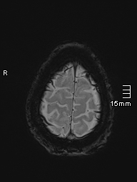 Basilar artery perforator aneurysm (Radiopaedia 82455-99523 Axial SWI 61).jpg