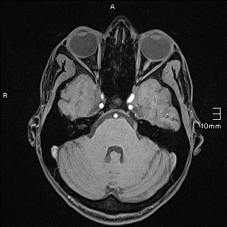 Basilar artery perforator aneurysm (Radiopaedia 82455-99523 F 35).jpg