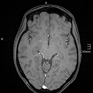 Basilar artery perforator aneurysm (Radiopaedia 82455-99523 F 65).jpg