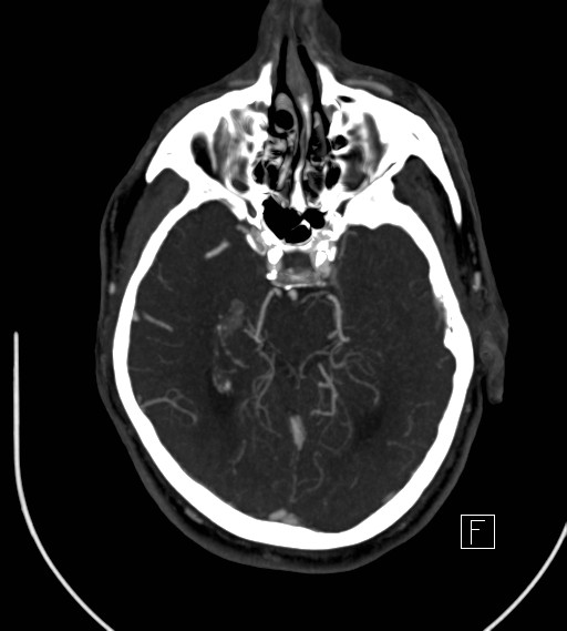 Basilar artery thrombosis (Radiopaedia 26986-27163 A 37).jpg