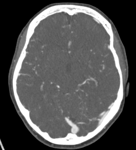 Basilar tip aneurysm with coiling (Radiopaedia 53912-60086 A 68).jpg