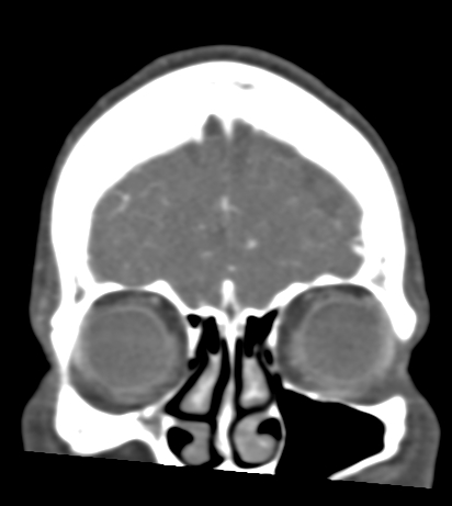 Basilar tip aneurysm with coiling (Radiopaedia 53912-60086 B 15).jpg