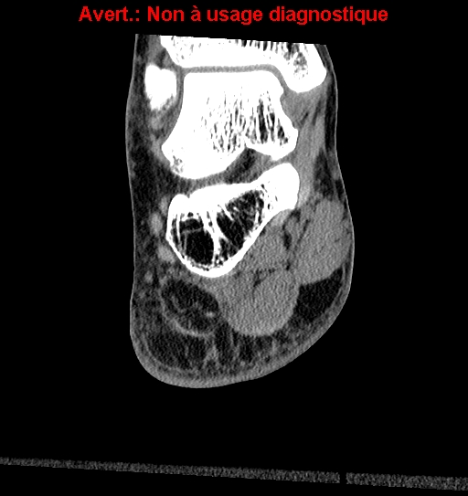 File:Baxter neuropathy (Radiopaedia 25988-26125 Coronal non-contrast 20).jpg