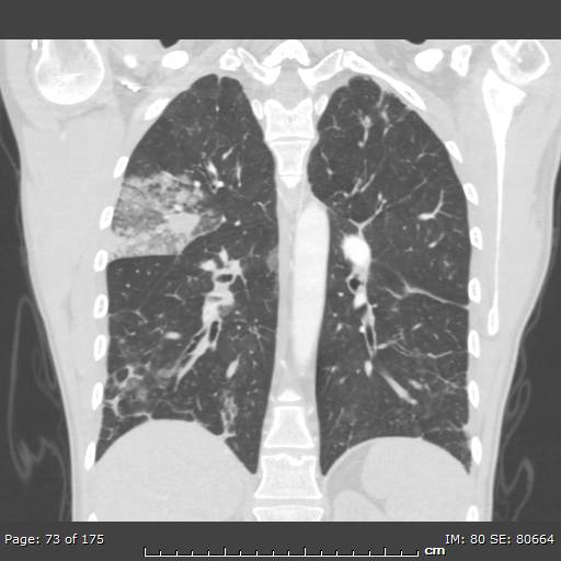 Behçet disease (Radiopaedia 44247-47889 Coronal lung window 20).jpg