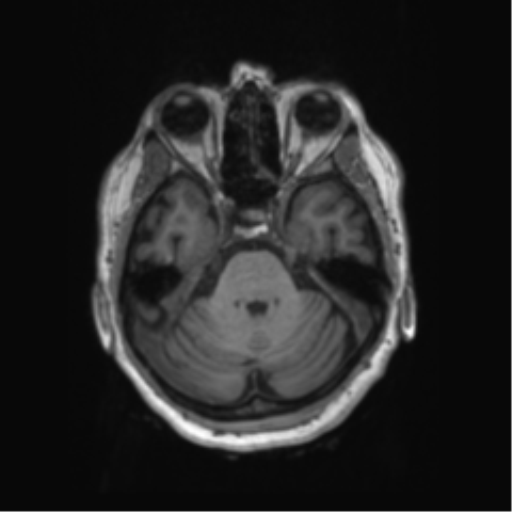 Behavioral variant frontotemporal dementia and late onset schizophrenia (Radiopaedia 52197-58083 Axial T1 78).png