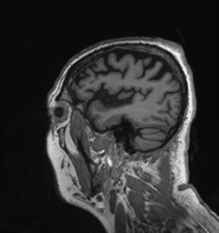 Behavioral variant frontotemporal dementia and late onset schizophrenia (Radiopaedia 52197-58083 Sagittal T1 88).png