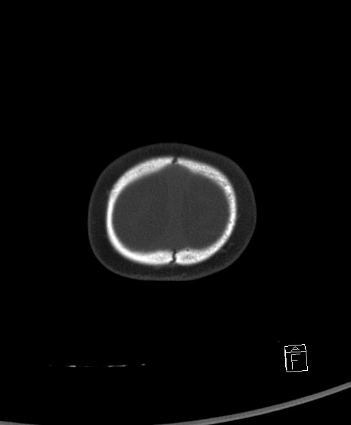 Benign enlargement of subarachnoid spaces in infancy (BESS) (Radiopaedia 87459-103795 Axial bone window 3).jpg
