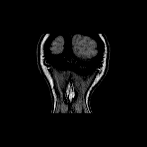 Berry aneurysm of the terminal internal carotid artery (Radiopaedia 88286-104918 Coronal TOF 121).jpg
