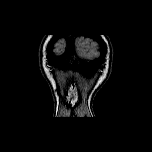 File:Berry aneurysm of the terminal internal carotid artery (Radiopaedia 88286-104918 Coronal TOF 122).jpg
