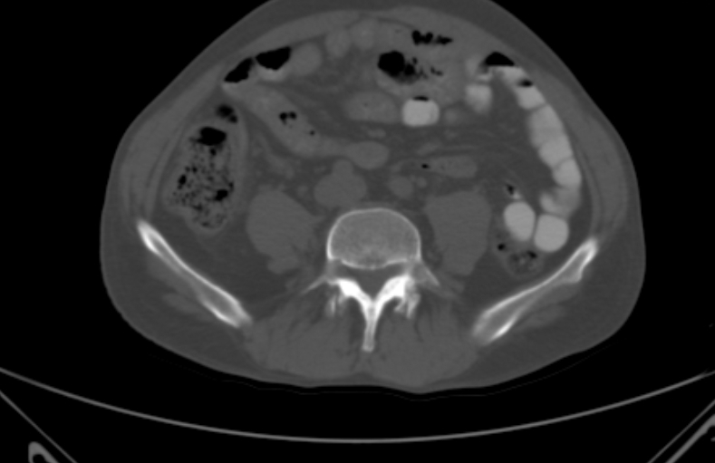 File:Bertolotti syndrome (Radiopaedia 58974-66235 Axial bone window 18).jpg