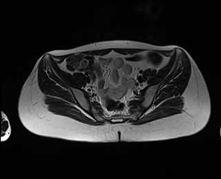 File:Bicornuate bicollis uterus (Radiopaedia 61626-69616 Axial T2 11).jpg