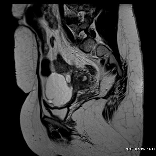 File:Bicornuate uterus- on MRI (Radiopaedia 49206-54297 Sagittal T2 18).jpg