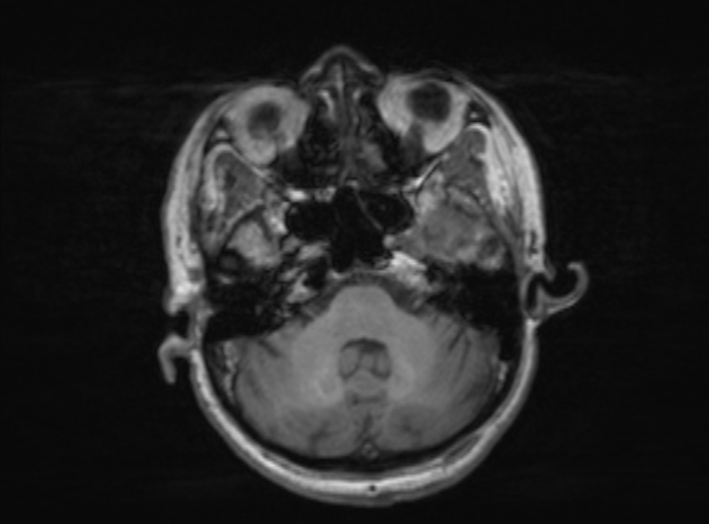 Bilateral PCA territory infarction - different ages (Radiopaedia 46200-51784 Axial T1 306).jpg