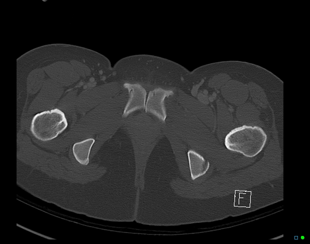 Bilateral acetabular fractures (Radiopaedia 79272-92308 Axial bone window 59).jpg